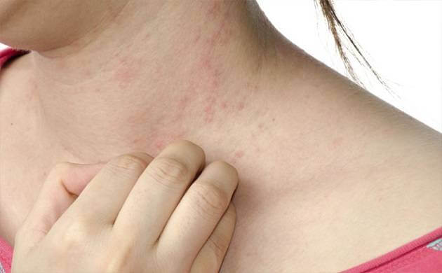 Artritis Psoriásica: ¿Qué tenemos que saber?