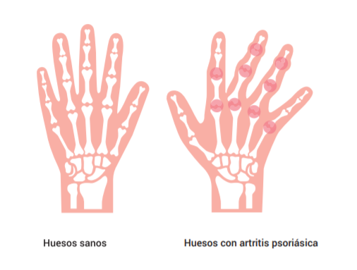 Artritis Psoriásica (un resumen)